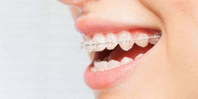 Centra Dental - Ceramic Houston Braces for Adults