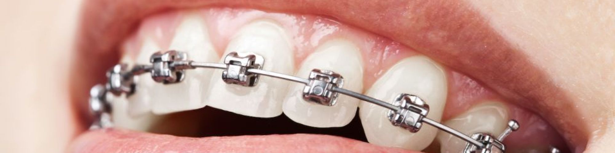 Centra Dental - Correct Overbites With Metal Dental Braces At Our South Houston Dentist