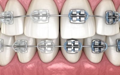 Centra Dental - Are Metal South Houston Braces Better Than Ceramic?