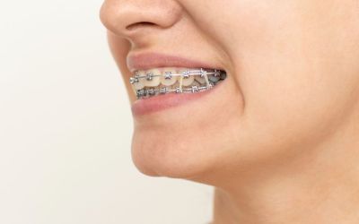 Centra Dental - Do All Houston Braces Patients Have To Wear Rubber Bands?