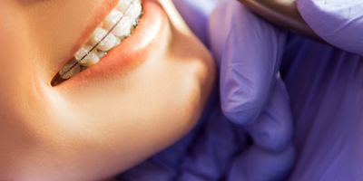 Centra Dental - Daily Habits for Optimal Houston Braces Hygiene