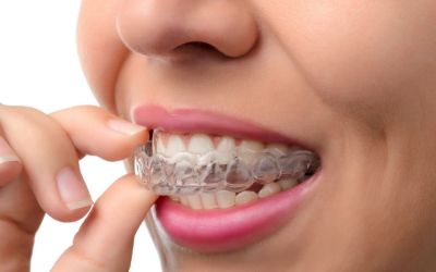 Centra Dental - Wearing South Houston Invisalign Instead Of Metal Braces