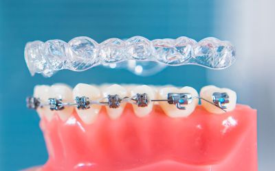 Centra Dental - A Comprehensive Guide to Different Types of Houston Braces