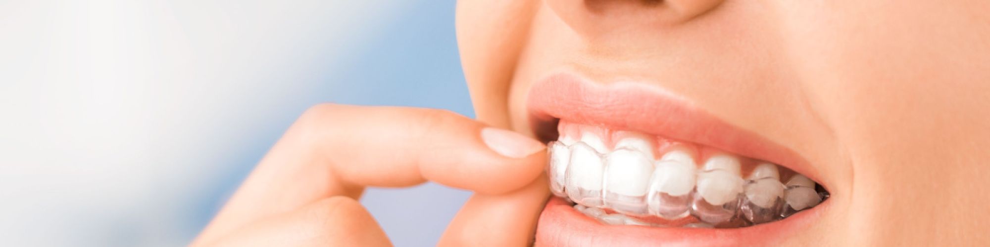 Centra Dental - Best Practices for Dental Hygiene with South Houston Invisalign