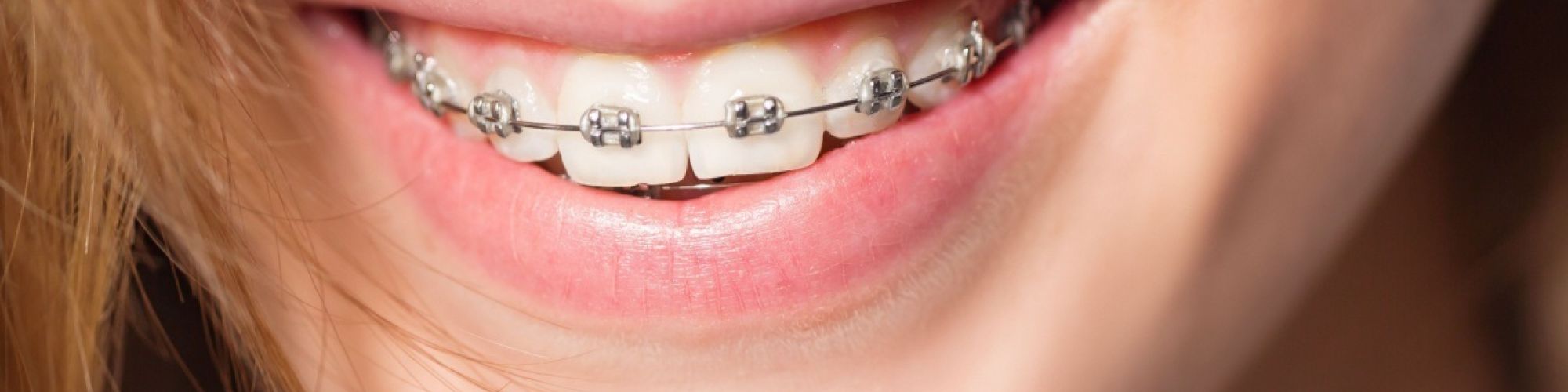Centra Dental - How to Keep Your Teeth Clean While Wearing South Houston Braces