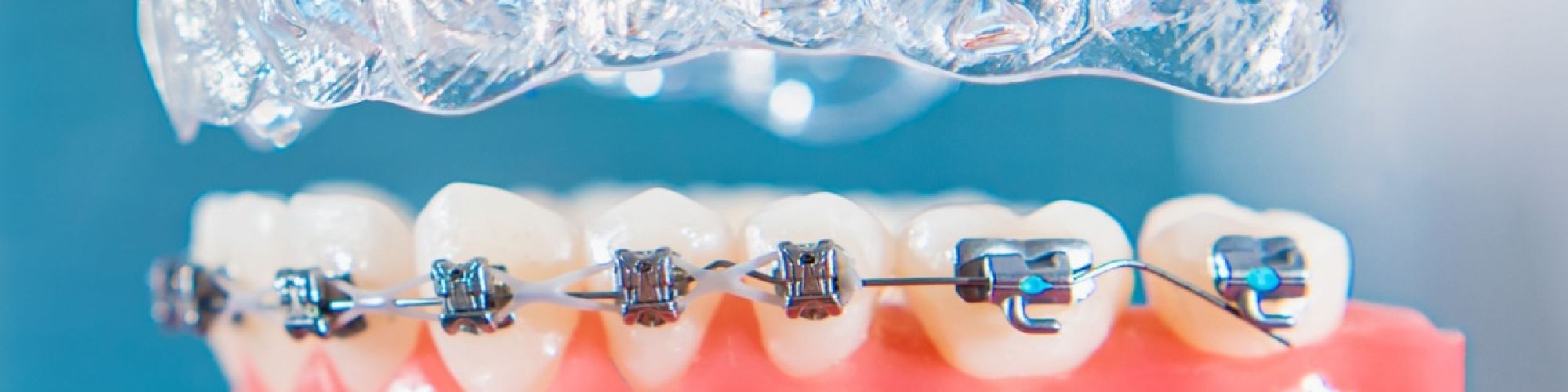 Centra Dental - A Comprehensive Guide to Different Types of Houston Braces