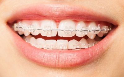 Centra Dental - Maintain Your South Houston Invisalign Smile With Clear Retainers