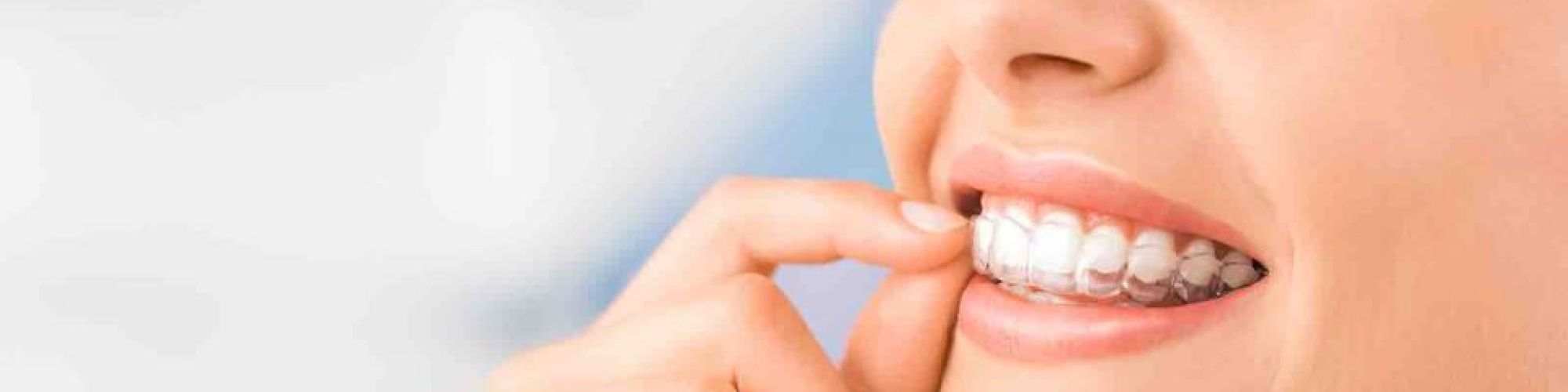 Centra Dental - Does Your Teen Need Braces? Get Invisalign