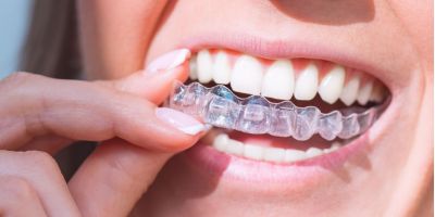 Centra Dental - Different Types of Retainers to Wear After Houston Braces