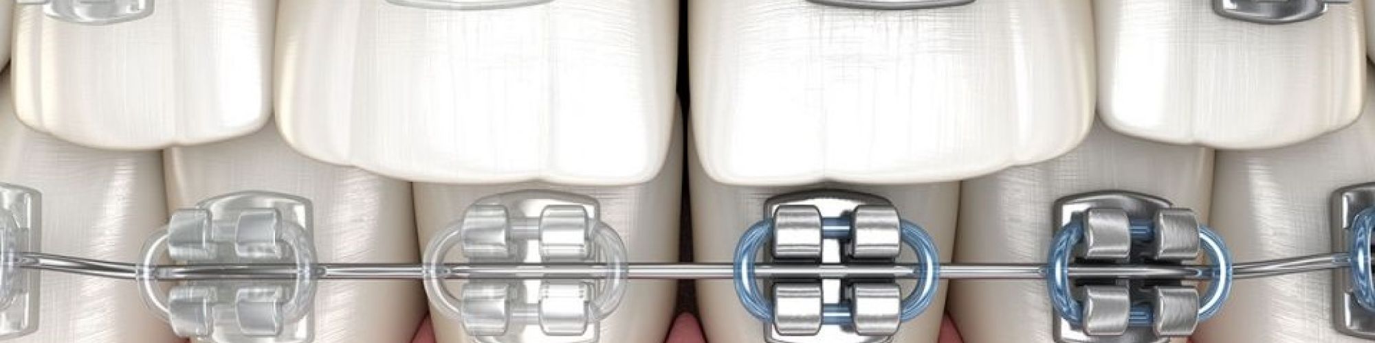 Centra Dental - Are Metal South Houston Braces Better Than Ceramic?