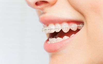 Centra Dental - Ceramic Houston Braces for Adults