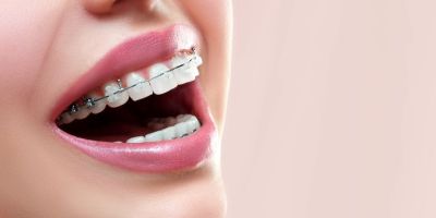 Centra Dental - Ceramic Houston Braces Versus Metal Dental Braces