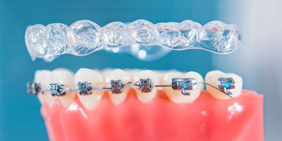 Centra Dental - A Comprehensive Guide to Different Types of Houston Braces