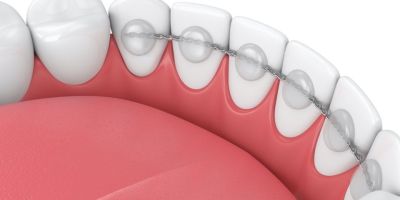 Centra Dental - Pros and Cons of Bonded Orthodontic Retainers After Houston Braces