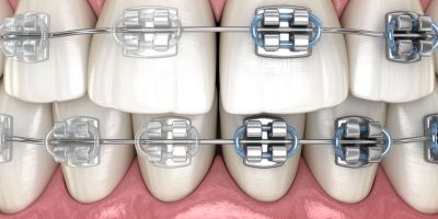 Centra Dental - Are Metal South Houston Braces Better Than Ceramic?