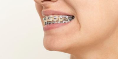Centra Dental - Do All Houston Braces Patients Have To Wear Rubber Bands?