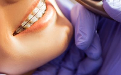 Centra Dental - Daily Habits for Optimal Houston Braces Hygiene