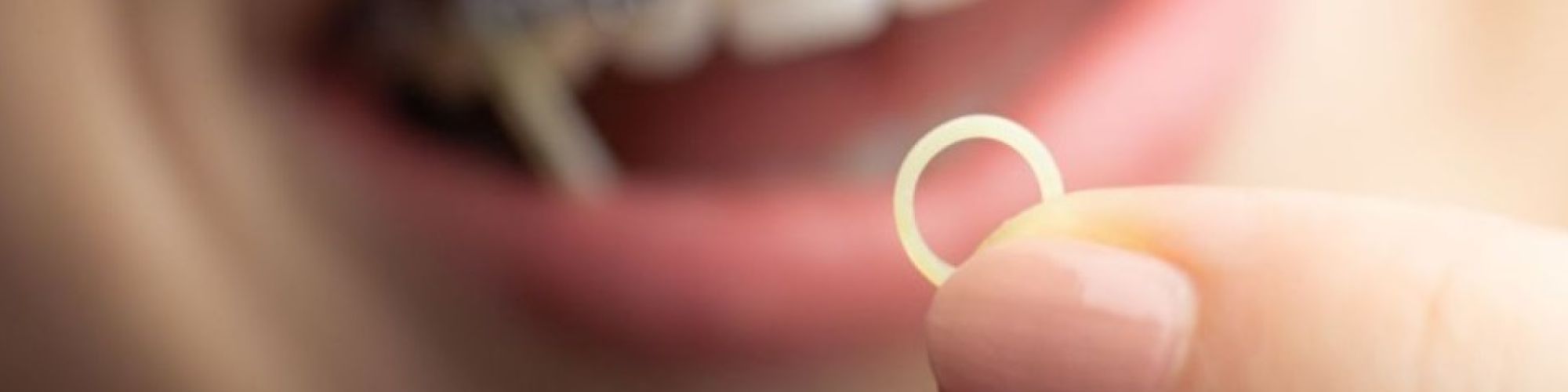 Centra Dental - Do All Houston Braces Patients Need Rubber Bands?