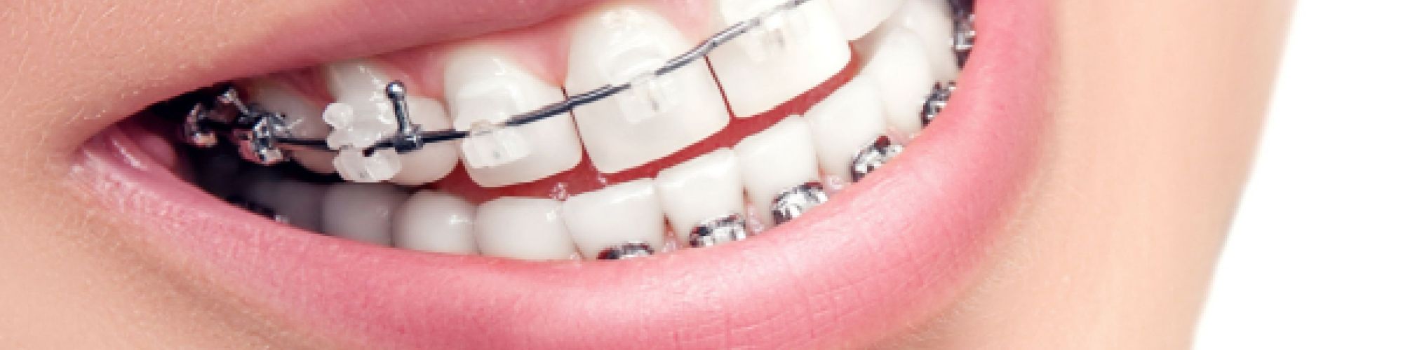 Centra Dental - When to Consider Houston Ceramic Braces for Your Child