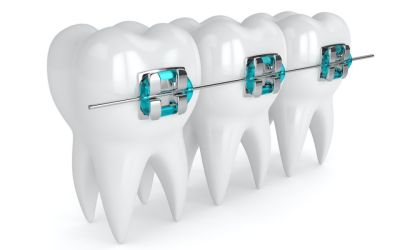 Centra Dental - What To Expect With Metal And Ceramic Houston Braces