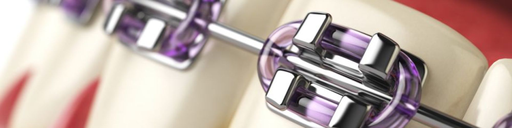 Centra Dental - How To Get The Most Out Of Metal Houston Braces