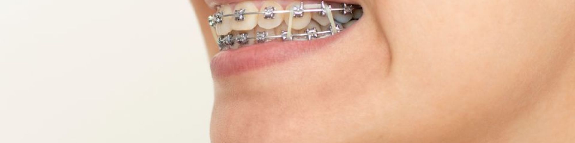 Centra Dental - Do All Houston Braces Patients Have To Wear Rubber Bands?