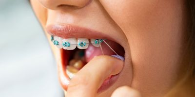 Centra Dental - Why Wearing Your Elastics With Houston Braces Is a Must
