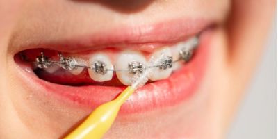 Centra Dental - How to Keep Your Teeth Clean While Wearing Houston Braces
