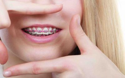 Centra Dental - Understanding How Braces at Our Houston Office Work