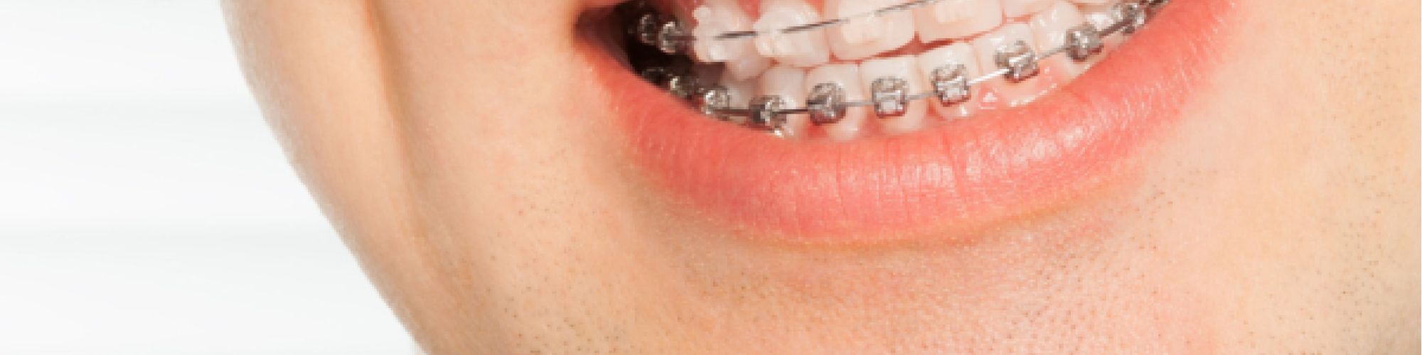 Centra Dental - Ceramic Braces vs. Traditional South Houston Braces: Which Is the Right Choice for You?