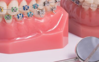 Centra Dental - Ceramic Houston Braces Versus Metal Braces