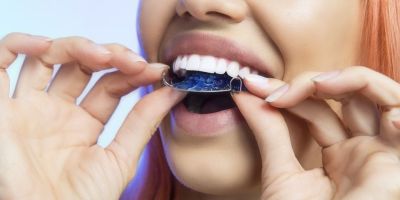 Centra Dental - Ceramic Houston Braces: The Perfect Compromise