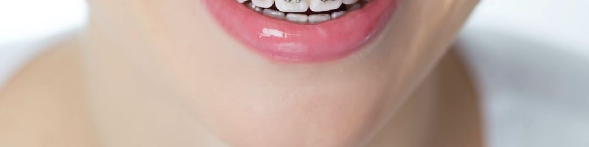 Centra Dental - How Metal Houston Braces Work