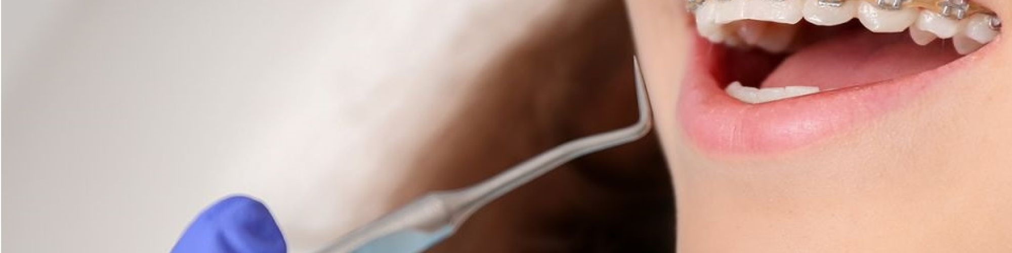 Centra Dental - Dental Cleaning With Braces by a South Houston Dentist